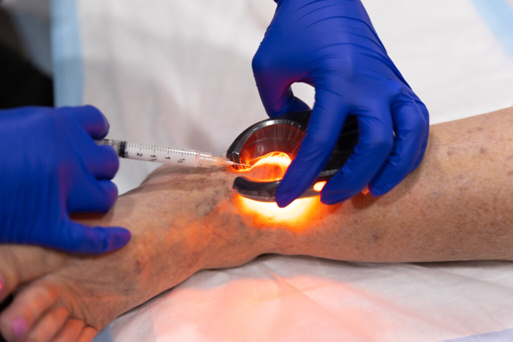 A vein specialist uses a vein-visualizing light to guide a sclerotherapy injection for vein treatment in Wellen Park.