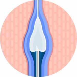 Graphic of a hypodermic needled adding liquid to a vein as part of Spider Vein Treatment in North Port, FL