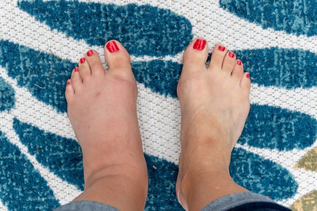 picture of 2 feet taken from the top, with the left foot swollen and in need of lymphedema treatment in North Port.